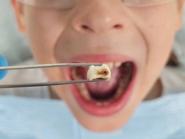 Best Emergency Dental Care for Broken or Chipped Teeth in Commercial Point, OH
